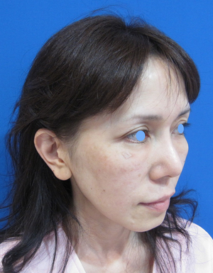 目の下のたるみ、目のくまでお悩みの方、切らずに完璧に解決します。TCB-R法　手術直後　症例写真